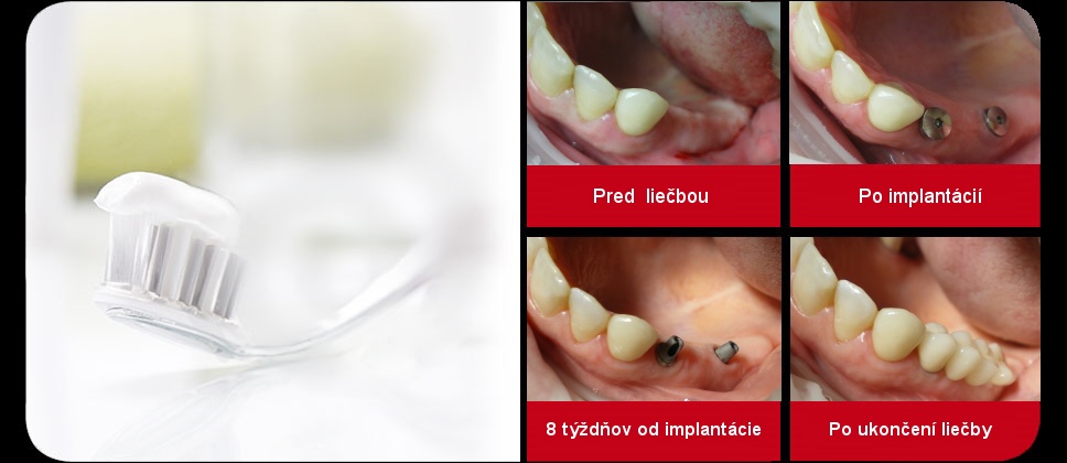 implantaty-skupina zubov-SK.jpg